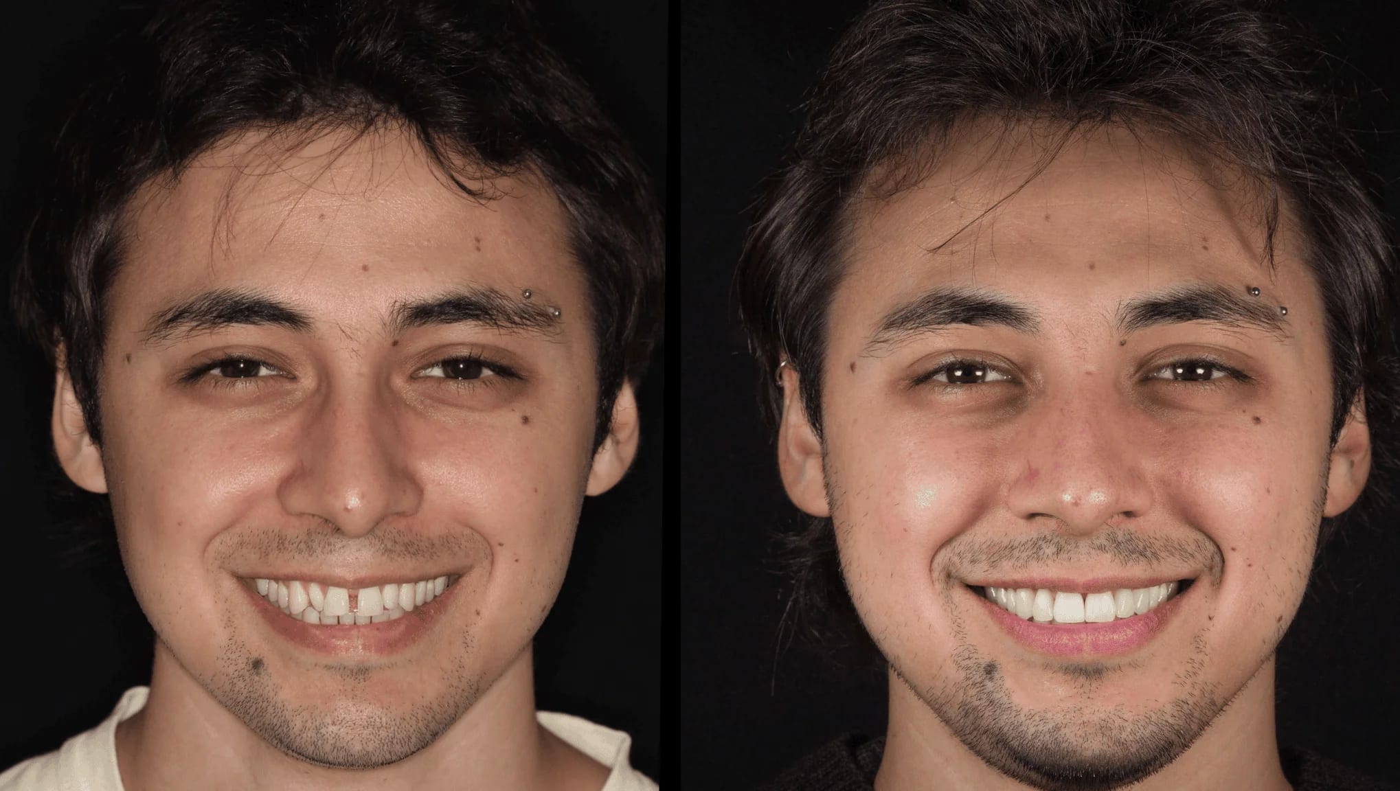 Caso extremo carillas veneers — Dr. Ariel Merino AM Estética Dental