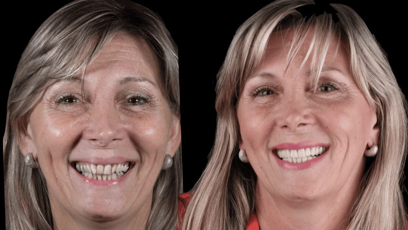 Caso extremo de transformación de sonrisa con carillas veneers — Dr. Ariel Merino AM Estética Dental
