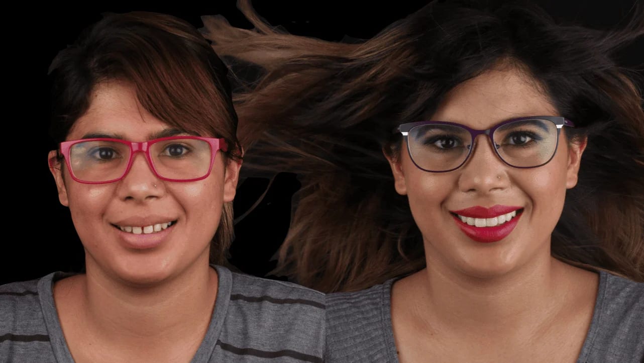 Caso extremo de diseño de sonrisa con carillas cerámicas — Dr. Ariel Merino AM Estética Dental
