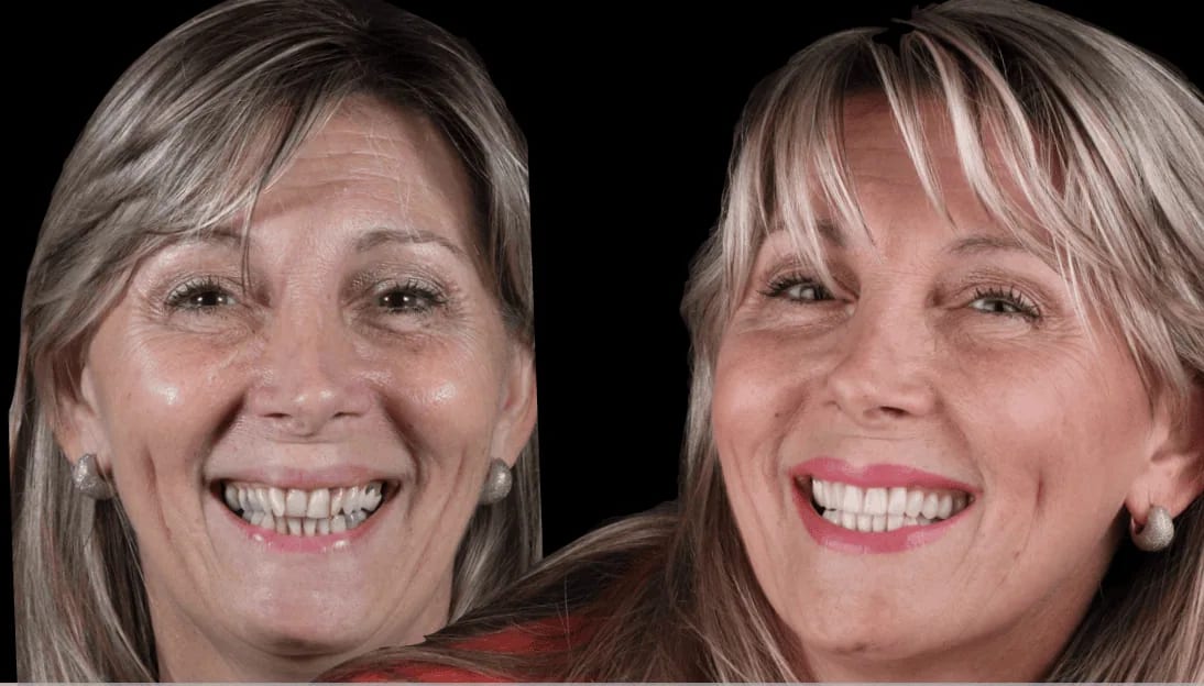Caso Patricia — diseño de sonrisa con carillas cerámicas — Dr. Ariel Merino AM Estética Dental