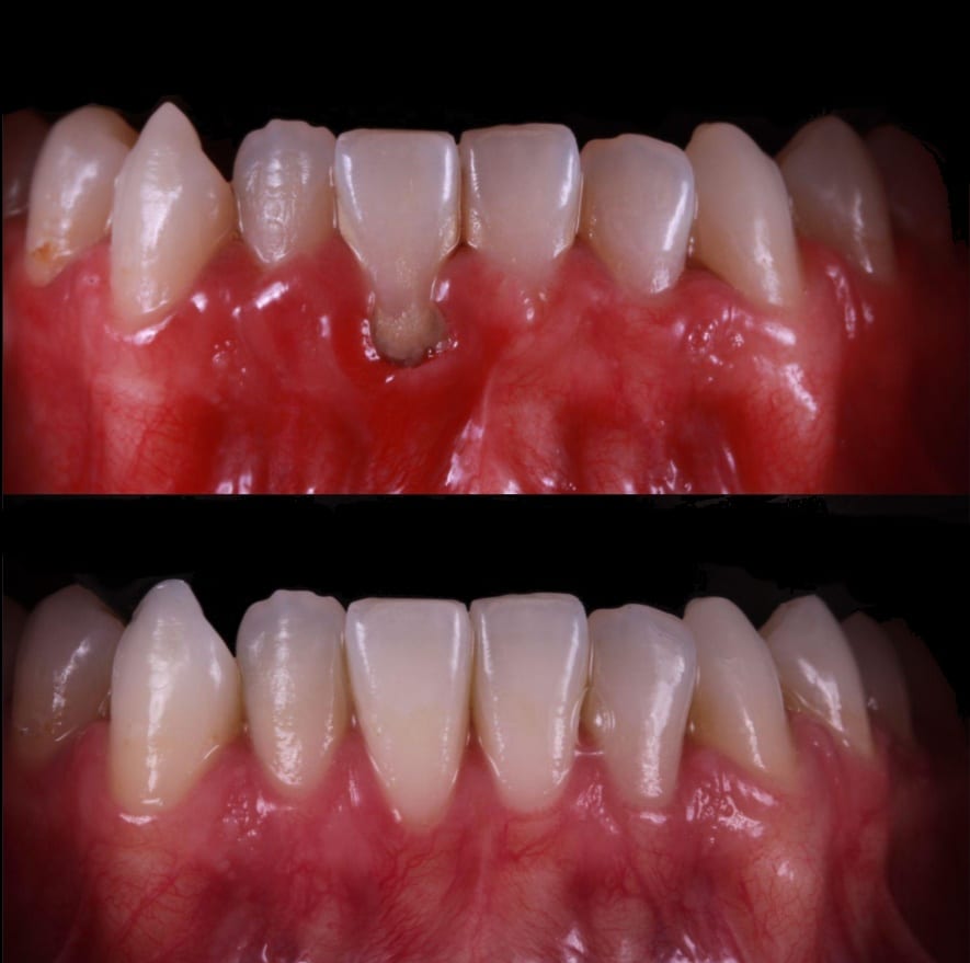 Antes y después de gingivectomía láser en el maxilar inferior — encía inflamada y agrandada vs. encía sana y contorneada — Dr. Ariel Merino AM Estética Dental Puerto Madero