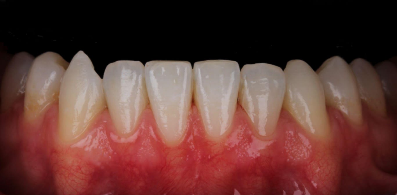 Limpieza periodontal con ultrasonido complementaria a la gingivectomía láser — AM Estética Dental Puerto Madero
