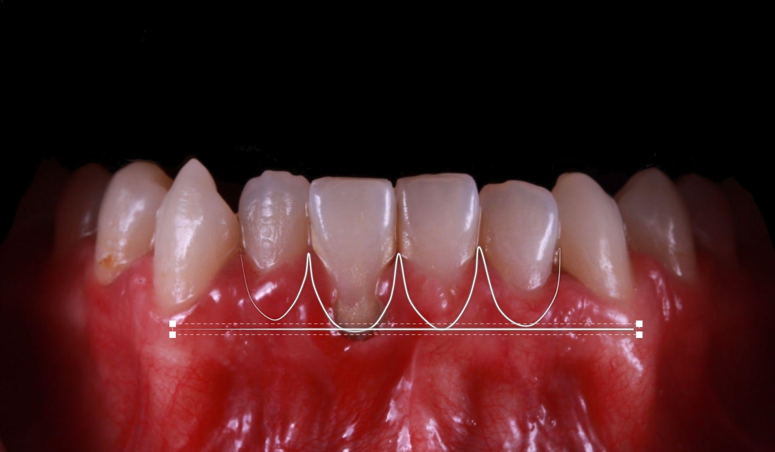 Planificación del remodelado gingival antes de la gingivectomía láser — AM Estética Dental Buenos Aires