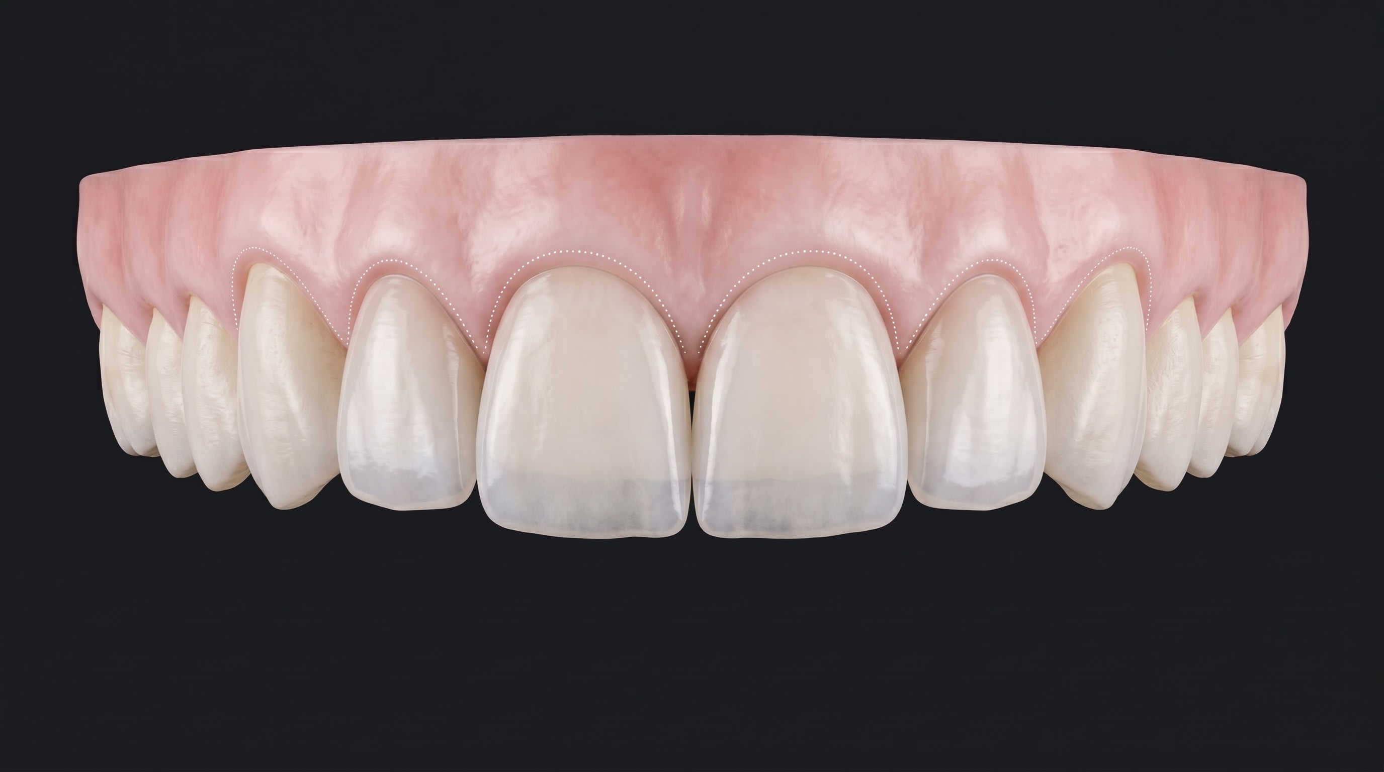 Render 3D de carillas de cerámica con análisis gingival — AM Estética Dental Puerto Madero