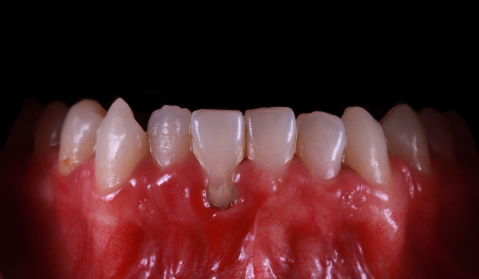 gingivectomia laser 06 registro intraoral inicial - gingivectomia laser 09 antes despues comparativa - AM Estetica Dental