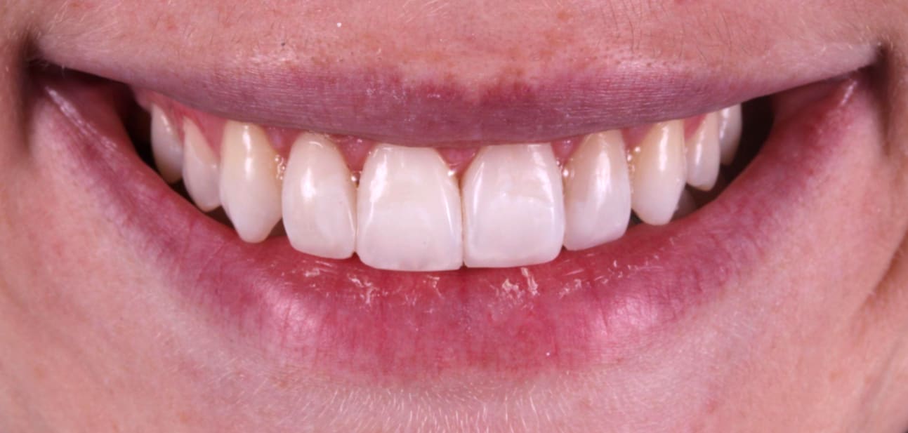 gingivectomia laser 05 sonrisa despues tratamiento - gingivectomia laser 10 procedimiento recorte gingival - AM Estetica Dental