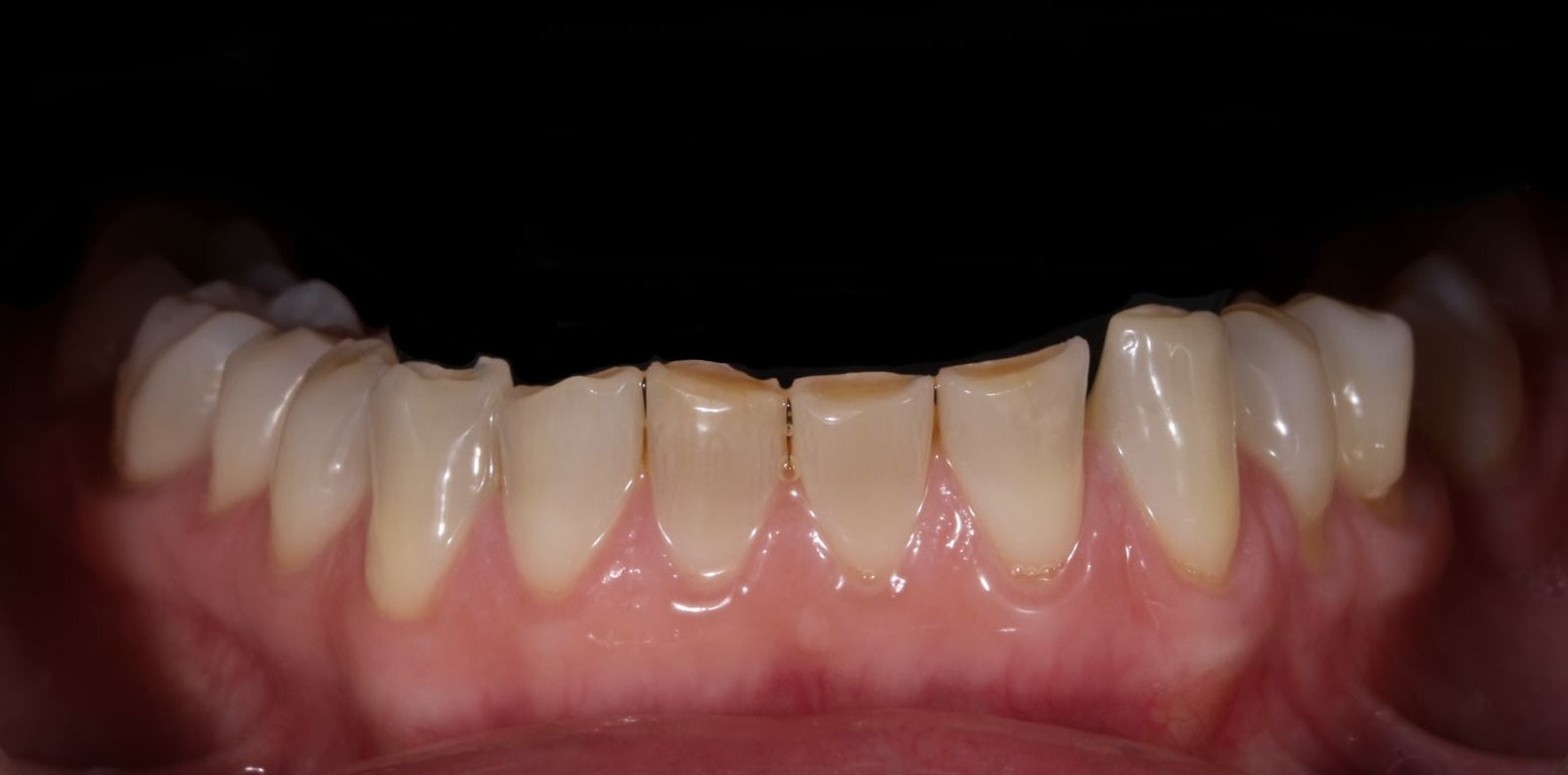 Esta es la foto anterior inferior donde se ven claras huellas de bruxismo.
 Esto es típico caso de bruxismo, donde se pueden apreciar los desgastes que se fueron haciendo año tras año.
 Foto inicial anterior inferior intraoral.