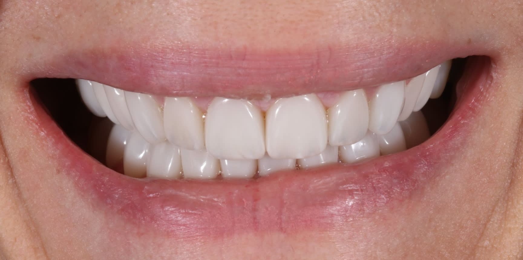 Imagen que documenta la simetría lograda entre ambas arcadas dentales después de las carillas.
