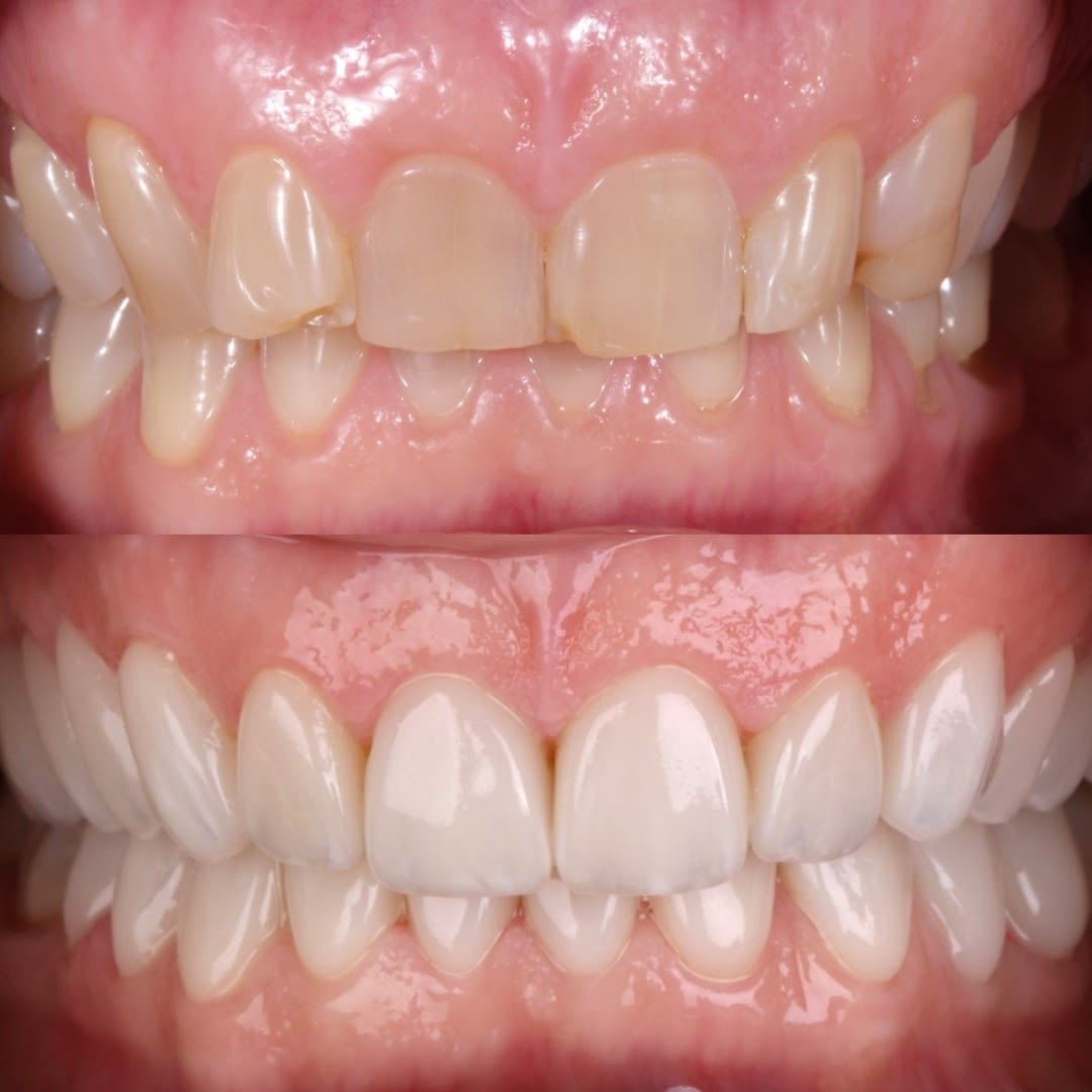 Foto antes y después de comparación de mordida.
 Con la mordida ya con carillas y sin carillas arriba.
 Y haces la comparación de cómo pudiste mejorar naturalmente el color de los dientes y mejorar la mordida.