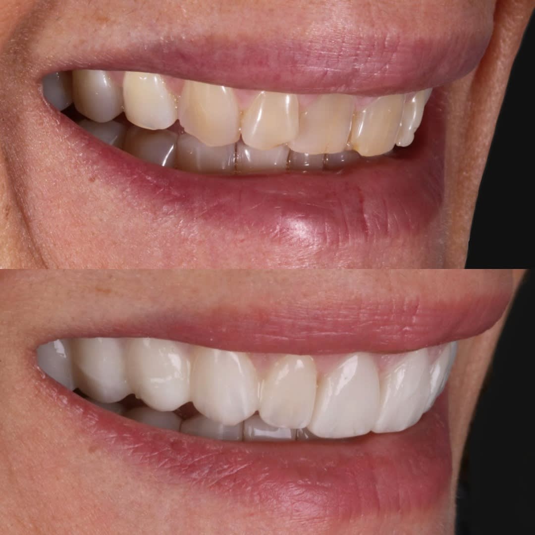 Y esta es una vista comparativa con carillas y sin carillas de la paciente, sonriendo lateralmente.
 Foto de labios, comparativa antes y después.
 Increíble.