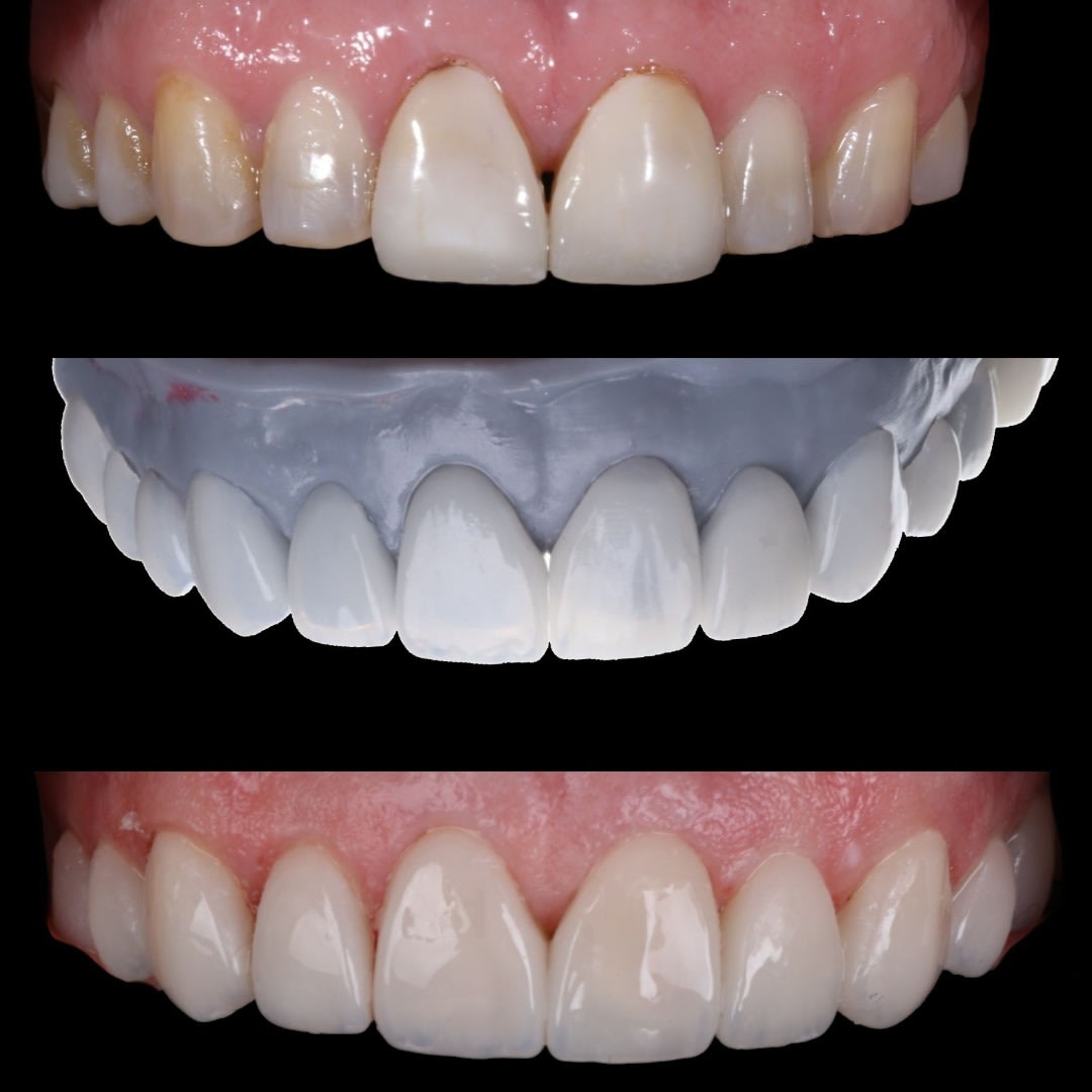 Perspectiva lateral de la sonrisa final, reflejando la proporción y naturalidad lograda en el tratamiento.
