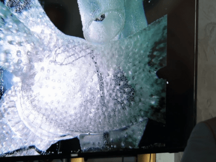 Сургутские кардиохирурги осваивают современные методики лечения аритмии