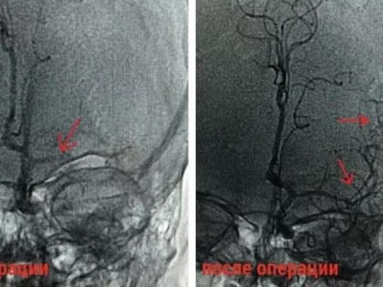 Врачи в Домодедове спасли 22‑летнюю девушку с инсультом