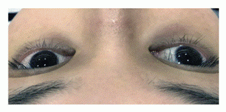 patient with mixture of vascular and pigmented skin dark circles patient with mixture of vascular and pigmented skin dark eye circles