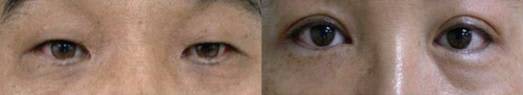 Dark eye circles—photo of eye bags caused by pigmentation