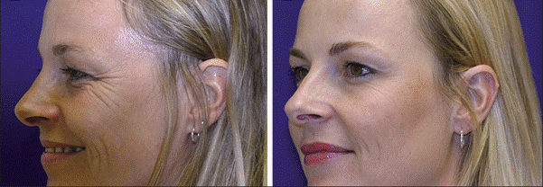 botox effect on wrinkles when smiling