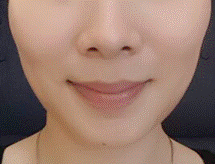 dr cy chua botox patient photo dr cy chua botox patient in SIngapore photo