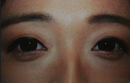 reduce false eye bags with botox