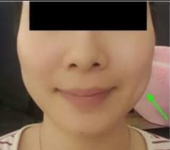 woman with bulky jaw muscles woman with bulky jaw muscles