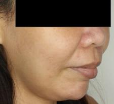 patient used botox on areas where botox doesn't work saggy face: patient used botox on areas where botox doesn't work