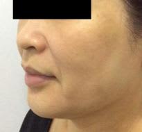 patient who had a double chin and lower face fat patient who had a double chin and saggy lower face fat