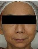 dr chua patient dr chua patient - skinboosters