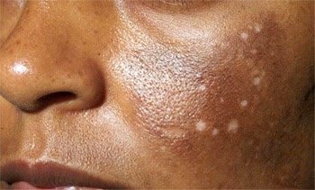 White spots on skin White spots on skin
