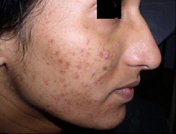 Hyperpigmentation Hyperpigmentation