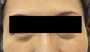 bulky lower eyelid under eye hollowing patient bulky lower eyelid under eye hollowing patient