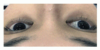 Patient with Vascular and pigmentation skin dark eye circles Patient with Vascular and pigmentation skin dark eye circles