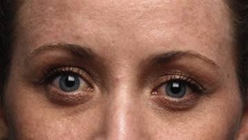 Female with bulky lower eyelid and tear trough sunkeness Female with bulky lower eyelid and tear trough sunkeness
