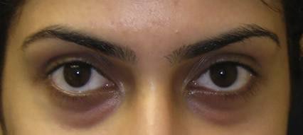 blood vessel congestion showing under the thin skin blood vessel congestion showing under the thin skin