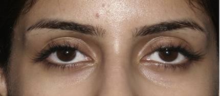 Post vascular laser treatment Post vascular laser treatment