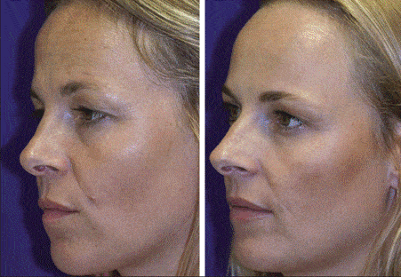 Botox differences between twins