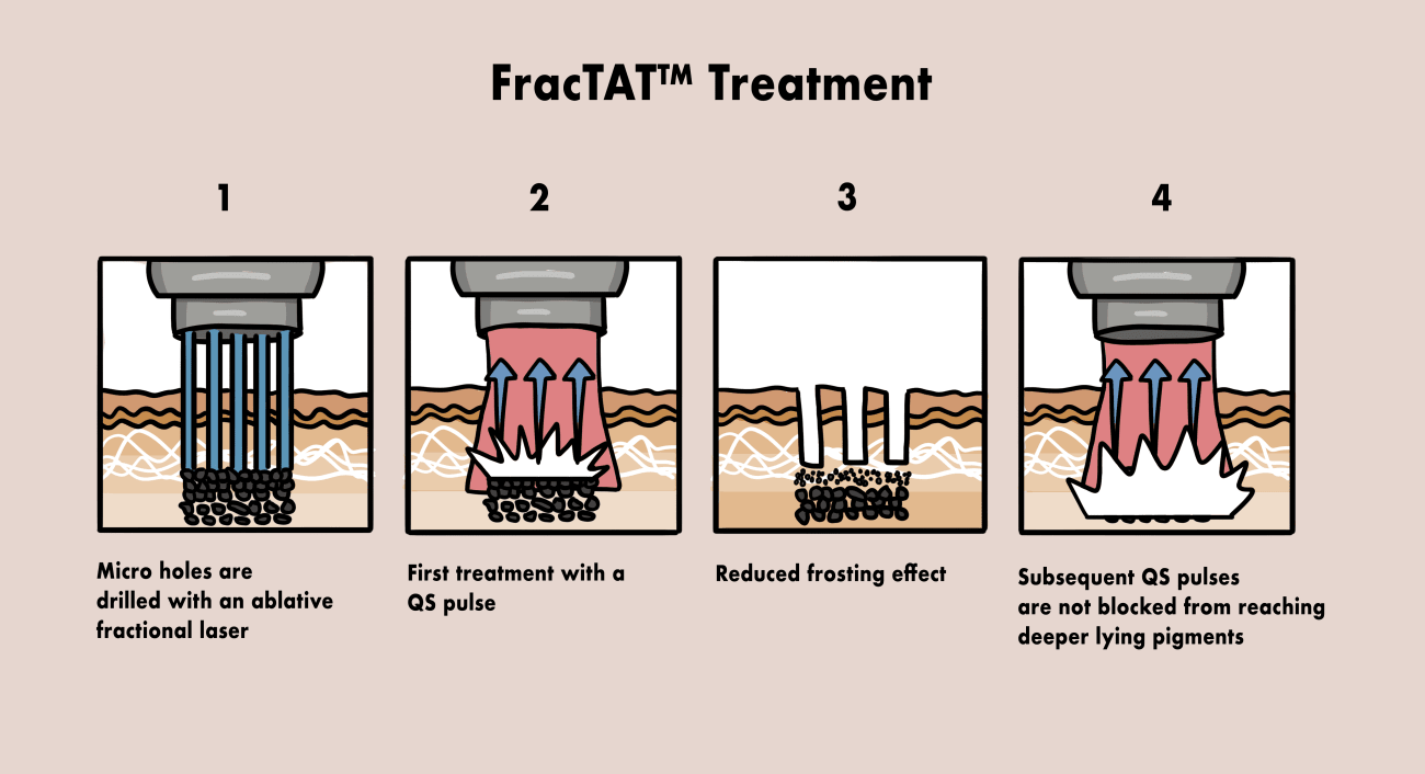 Why Normal Tattoo Removal Lasers Don’t Work as Well as This Does ...