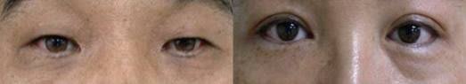 pigmented lower eyelids pigmented lower eyelids