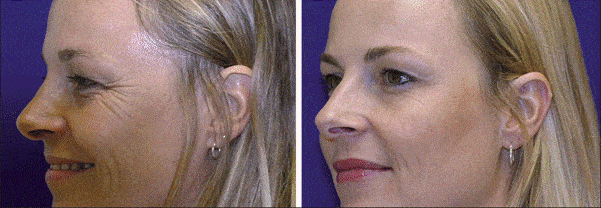 dynamic wrinkles effect