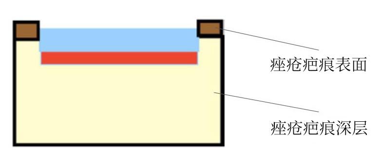 diagram ablative full beam laser