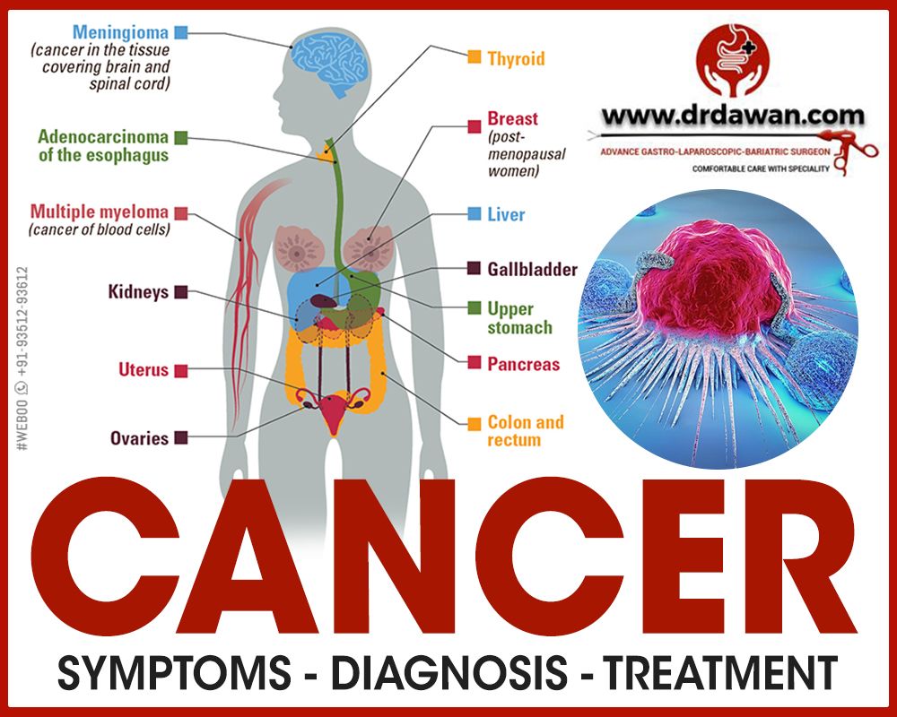 Cancer Symptoms Diagnosis and Treatment in Bikaner | Dr. Manohar L.Dawan -  General & Laparoscopic Surgeon, Gastrointestinal Surgeon, Oncosurgeon,  Bariatric Surgeon | General Surgeon in Bikaner