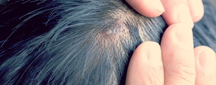 Scalp Psoriasis - Flaym