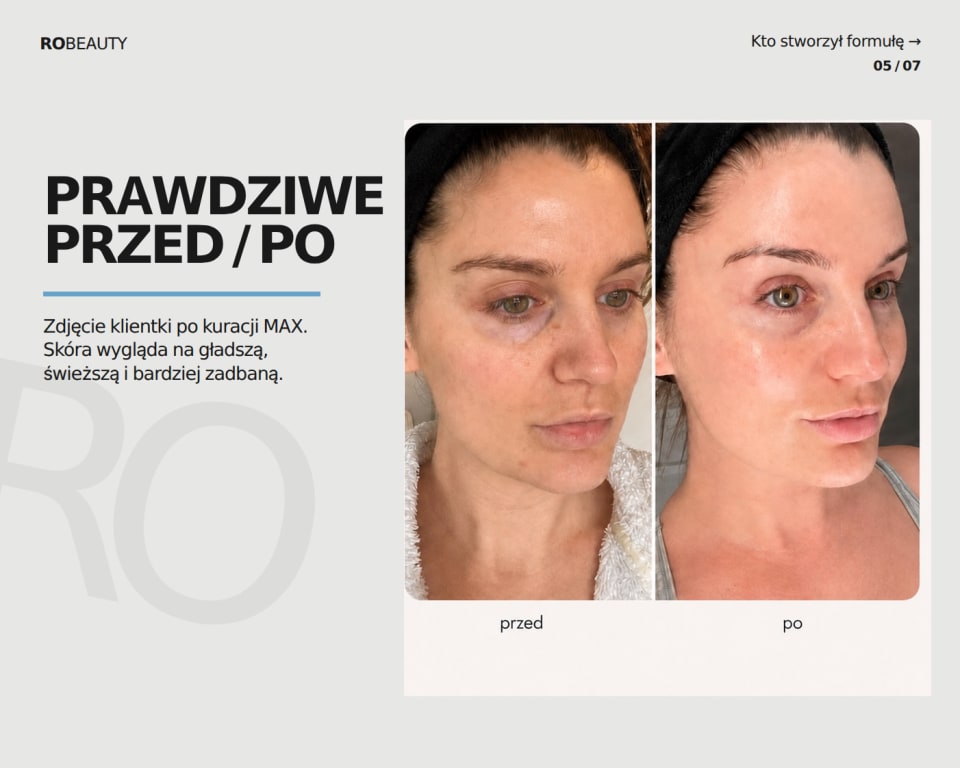 Prawdziwe przed / po — zdjęcie klientki po kuracji MAX