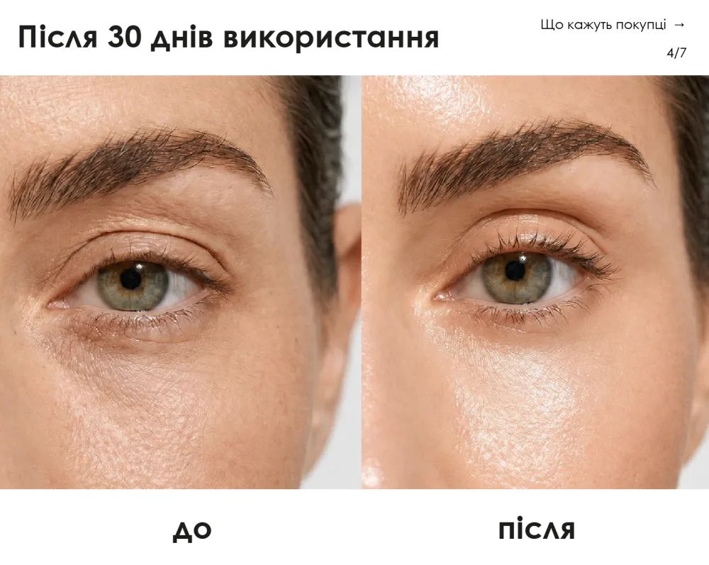 BEAUTIFEYE® — до і після