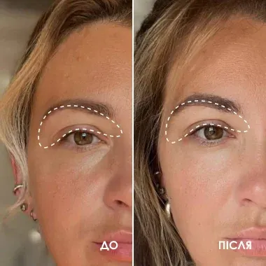 До і після BEAUTIFEYE®: зона повік, приклад 3