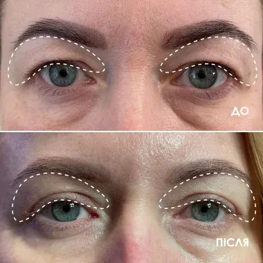 До і після BEAUTIFEYE®: зона повік, приклад 2