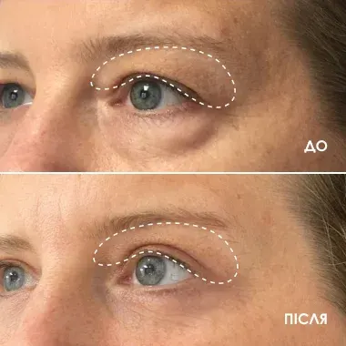До і після BEAUTIFEYE®: зона повік, приклад 1