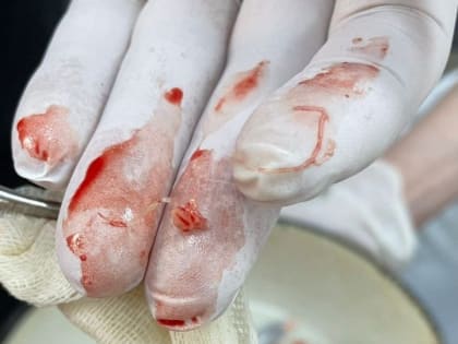 В Саратове из ноги мужчины врачи достали живого червя