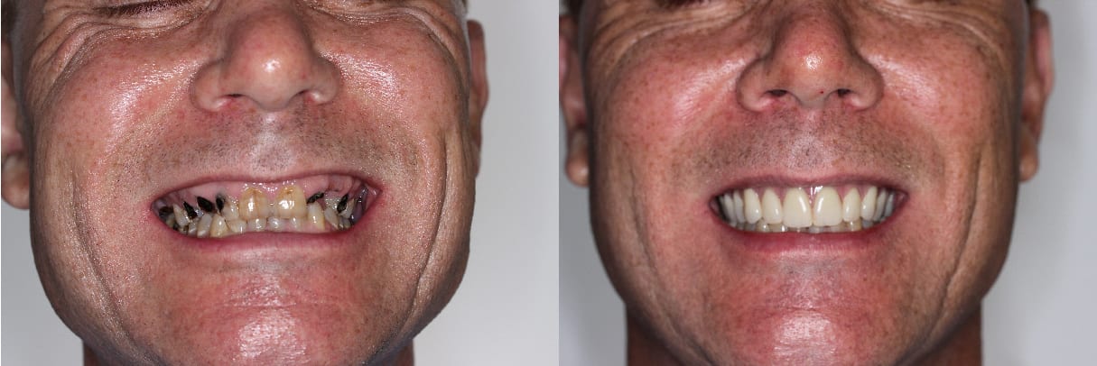 john Life-Changing All-on-4® Treatment by Dr. Falender