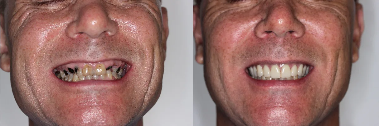 john Life-Changing All-on-4® Treatment by Dr. Falender