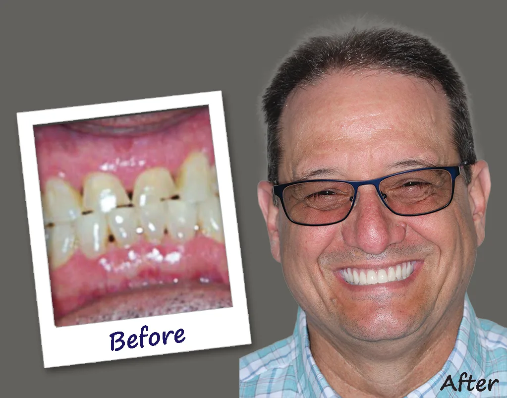 Barry hid his smile until the All-on-4 treatment. Now, he can smile, eat and talk confidently.