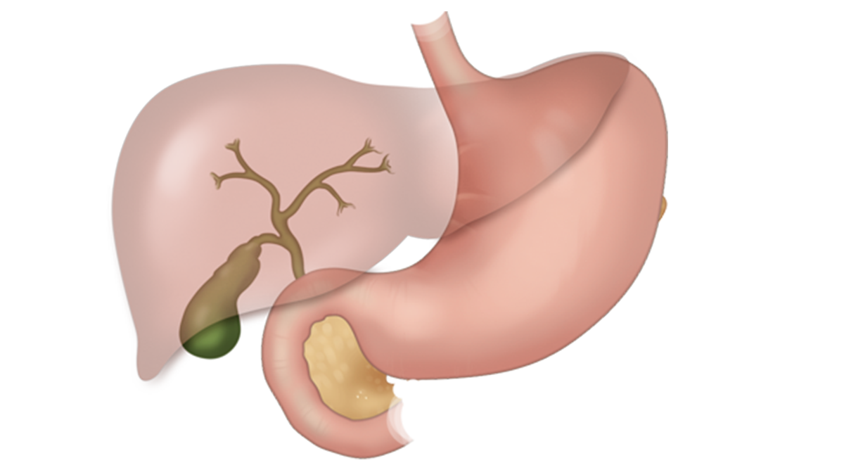 Панкреатит и желчекаменная болезнь. Желчнокаменная болезнь иконки. Печень без желчного